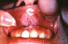 Mouth Cancer 3>1. Smokeless tobacco use is responsible

for the development of a portion of <u>oral leukoplakias</u> in

both teenage and adult users. The degree to which the use of

smokeless tobacco affects the oral had and soft tissues is

variable depending on the site of action, type of smokeless

tobacco product used, frequency and duration of use, predisposing

factors, cofactors, such as smoking or concomitant gingival

disease and other factors not yet determined. </p>



<p>1. Dose response effects have been noted by a number of

investigators. Longer use of smokeless tobacco results in a

higher prevalence of leukoplakic lesions. Oral<u> leukoplakias

are commonly found at the site of tobacco placement</u>. </p>



<p><img src=